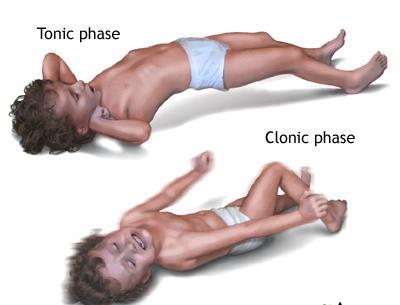 Slika 6.3.1.1. Tonička i klonička faza febrilnih konvulzija kod djece Izvor: https://medlineplus.gov/ency/imagepages/19076.htm 6.3.2.