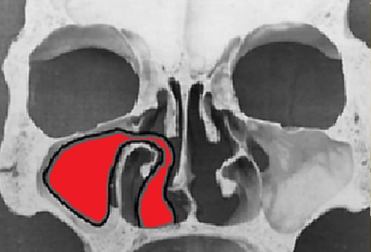 1.1. Antrokoanalni polip Antrokoanalni polip (ACP) je unilateralni benigni tumor sinusa i nosa koji potječe iz sluznice maksilarnog sinusa u kojem raste, širi se u nosnu šupljinu i proteže se do