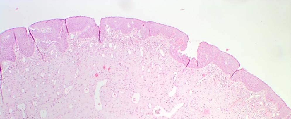 Polipi u DNP-u obično sadrže oskudne mukozne žlijezde, imaju miksoidnu stromu s varijabilnom količinom upalnih stanica u blizini njihove površine, a kod ACP-a su upalni infiltrat, mukozne žlijezde i