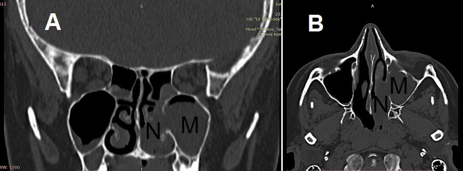 CT obično pokazuje mekotkivnu tvorbu koja ispunjava maksilarni sinus, proteže se u nosni kavum gdje poglavito opacificira srednji nosni hodnik te ekstenziju tvorbe kroz koanu u epifarinks (slike 1.6.