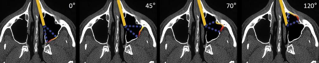 je potrebno, za endoskopski prikaz u maksilarnom sinusu koriste se optike pod različitim kutovima (slika 1.8)