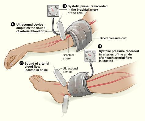 mjerenje tlaka u nogama kumin liječenje hipertenzije