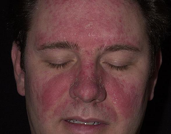 Seborojični dermatitis javlja se u 3 do 5% stanovništva, nešto češće u muškaraca (6).