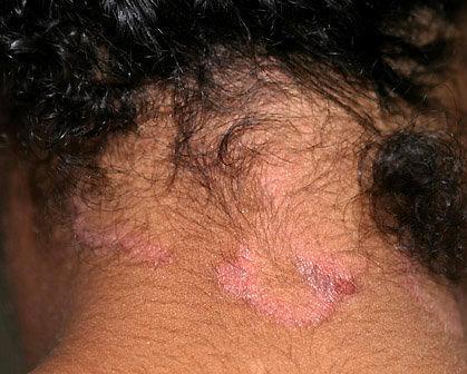 omeďenih suhih naslaga (3). Slika 6. Dermatitis seborrhoica colli perstans (Izvor: www.atlasdermatologico.com.
