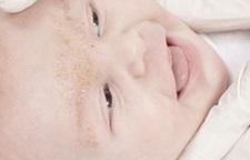 1.5. DERMATITIS SEBORRHOICA INFANTUM 1.5.1. Kliniĉka slika U dojenčadi, obično u prva tri mjeseca ţivota (najčešće izmeďu trećeg i desetog tjedna), promjene počinju u vlasištu pojavom bjelkastih