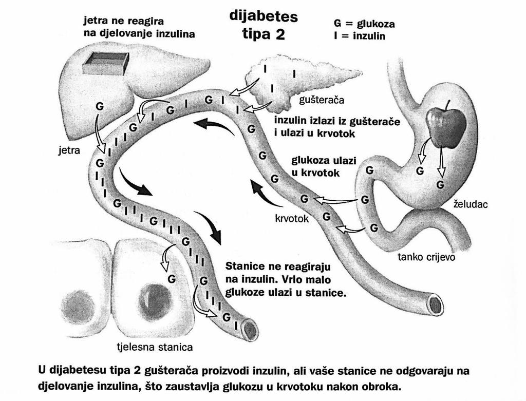 Slika 2. Šećerna bolest tip 2 Gestacijski dijabetes je oblik koji se javlja tijekom trudnoće. Povećane razine hormona koje se luče tijekom trudnoće povećavaju rezistenciju tkiva na inzulin.