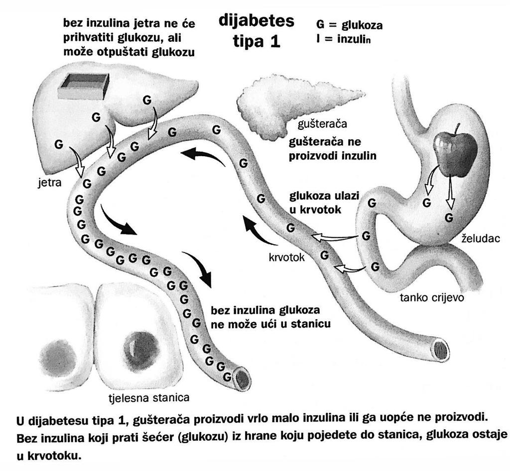 Tip 1 je autoimuna bolest koju karakterizira razaranje β-stanica gušterače te posljedično nedostatak inzulina i sklonost razvoju dijabetičke ketoze (Slika 1).