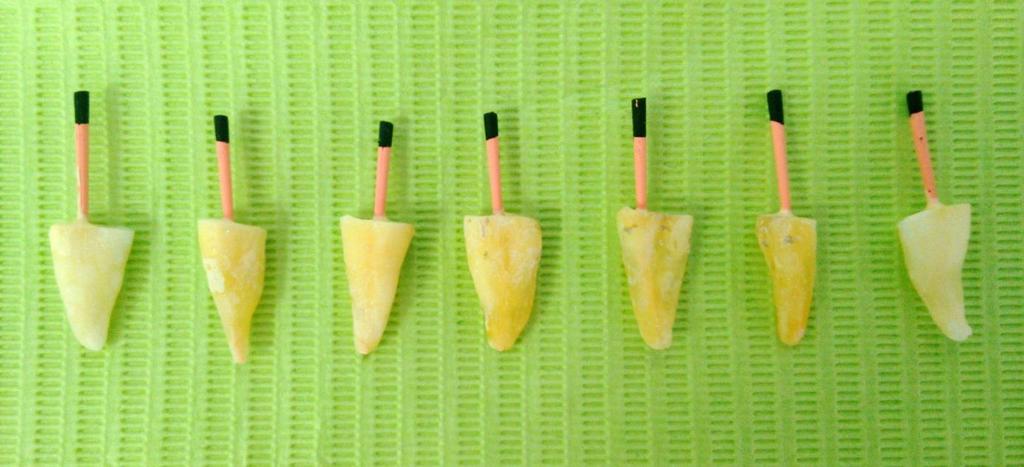 Obrađeni korijenski kanali posušeni su Reciproc papirnatim štapićima veličine #40 (VDW, München, Njemačka) te napunjeni pripadajućim Reciproc gutaperka štapićem #40 (VDW, München, Njemačka) i AH Plus