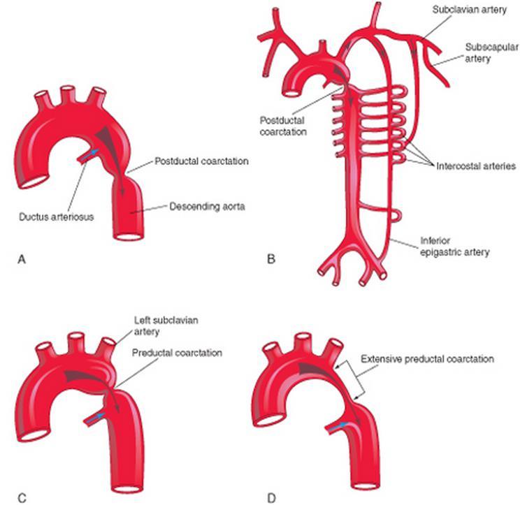 koarktacije aorte pomiješa hipertenzije)