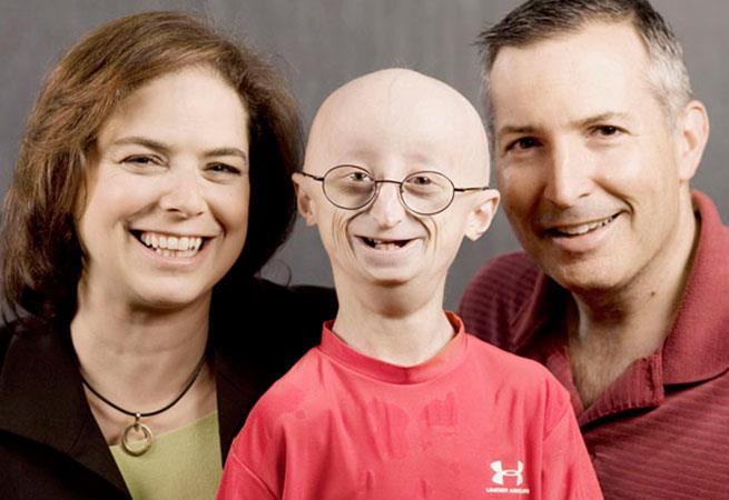 Slika 10. Progerija (peuzeto s : http://www.info-ks.net/clanak.php?id=39398) 4.