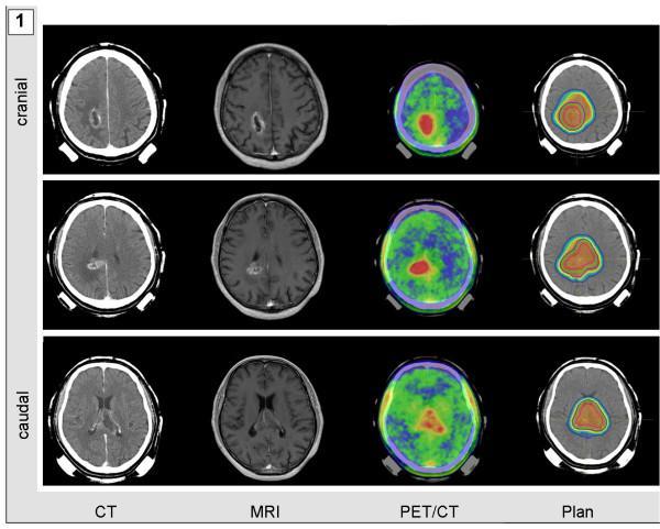 Slika 4. CT, MR i PET/CT snimke glioblastoma, te spojene snimke za plan radioterapije Preuzeto s: https://www.researchgate.