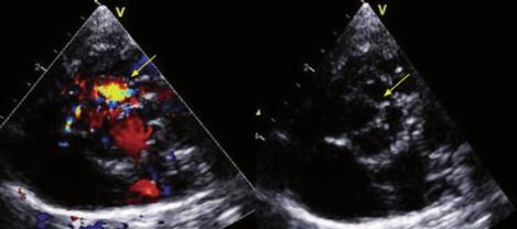 uzrokovane insuficijencijom aortalnog ušća. Rendgenska slika torakalnih organa novorođenčeta očituje se izrazitom kardiomegalijom na račun lijeve klijetke i sumnje na dilataciju uzlazne aorte.