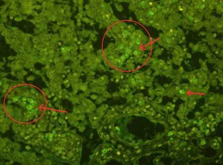 Slika 17. Histološki prerez limfnog čvora dijabetičnog miša tretiranog koštanom srži. Citoplazme stanica su pozitivne na Pdx-1.
