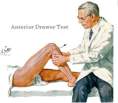 3.6.3. Тест предње фиоке - Drawer test Испитивање се изводи тако да испитаник лежи на леђима са повређеном ногом савијеном у зглобу кука под углом од 45 степени, и у зглобу колена савијеном под углом