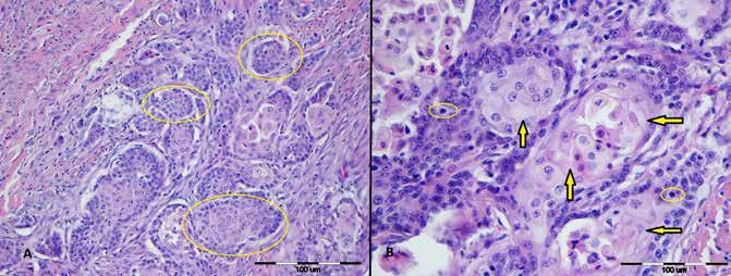 PROVJERITE SVOJE ZNANJE Stručni rad Slika 5. Histološki prikaz planocelularnog karcinoma. A. Uočavaju se brojni otočići sastavljeni od neoplastičnih epitelnih stanica (označeno žutim elipsama).