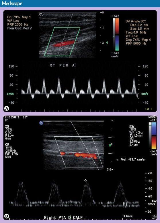Slika 11.1. Arterijski kolor dopler ultrazvučni prikaz (A) Prikaz zdrave peronealne arterije sa trifazičnim signalom (B) Prikaz a.
