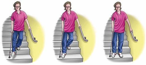 Kretanje stepenicama uvijek ići jednu po jednu stepenicu, pri tom se jednom rukom pridržavati rukohvata, prilikom kretanja prvo osloniti pomagalo potom bolesnu i na posljetku zdravu nogu. Slika 5.