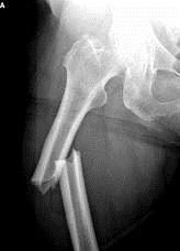 1.2. PRIJELOM BEDRENE KOSI Slika 2. Prijelom bedrene kosti (Preuzeto: http://www.medicalzone.net/emergency-strategy---how-to-treatfracture-of-the-femur.