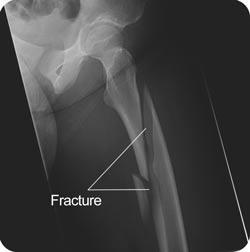 Slika 3. Prijelom bedrene kosti (preuzeto: http://orthoanswer.org/hip/femur-fractures/investigations.