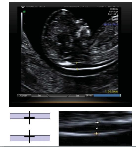 Slika 1. Postavljanje kalipera prilikom mjerenja VP Sliku VP treba dobiti sa sagitalnim pogledom na fetus u neutralnom položaju.
