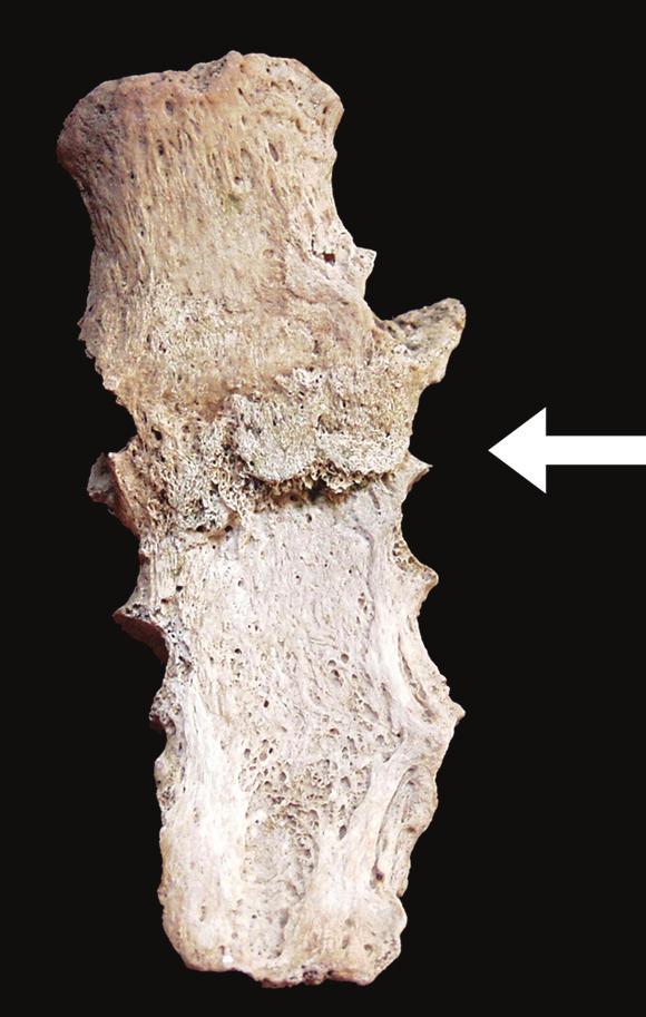 stira se u obliku osteofita, dok je tek u nekoliko slučajeva uočena prisutnost osteoartritisa u obliku poroznosti i/ili eburnacije.