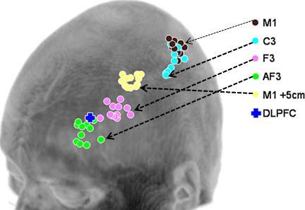 područja (Brodman area - BA) 9 i granice BA 9 i 46 predstavlja ključni region DLPFK čijom stimulacijom se postiže bolja antidepresivna efikasnost u poređenju sa standardnim pozicioniranjem kalema.