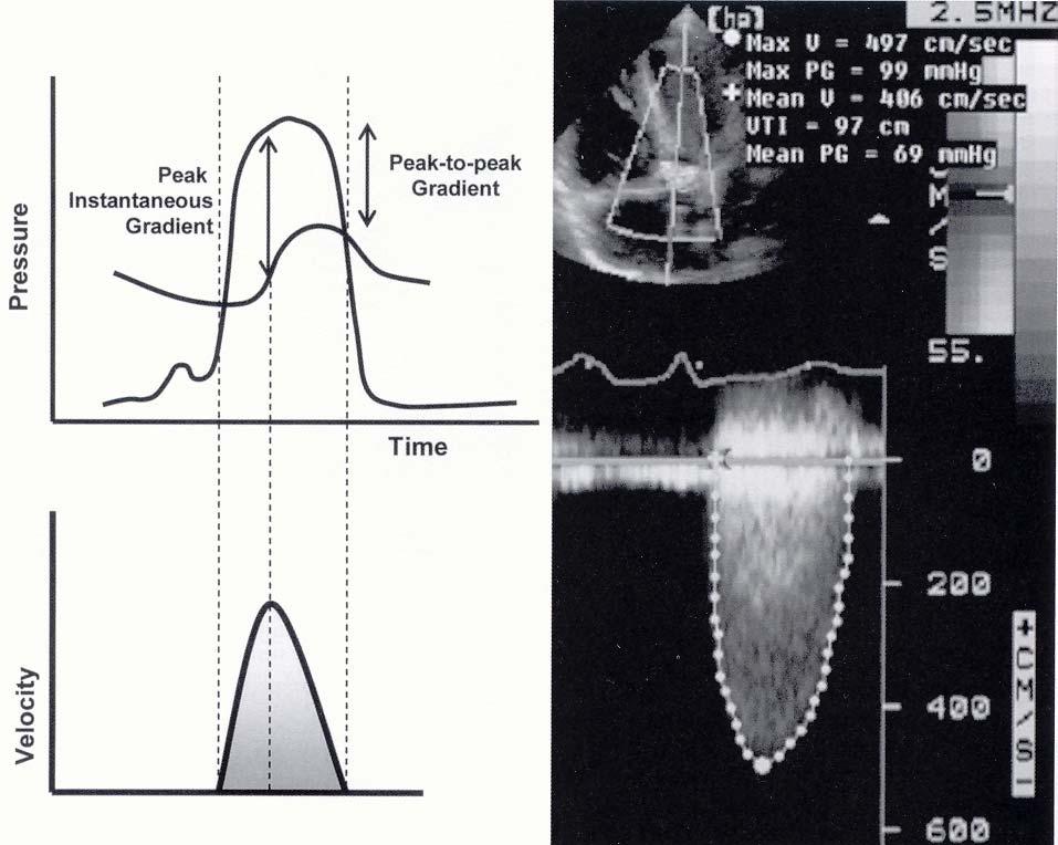 УВОД На ово указује звучни сигнал који постаје високофреквентан писак, скоро неподношљив за слушање када је ултразвук под малим углом усмерен према млазу крви највеће брзине.