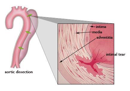 УВОД Дефиниција Дисекција аорте је једно од најтежих оболења аорте које се карактерише развојем пукотине у интималном слоју аорте.