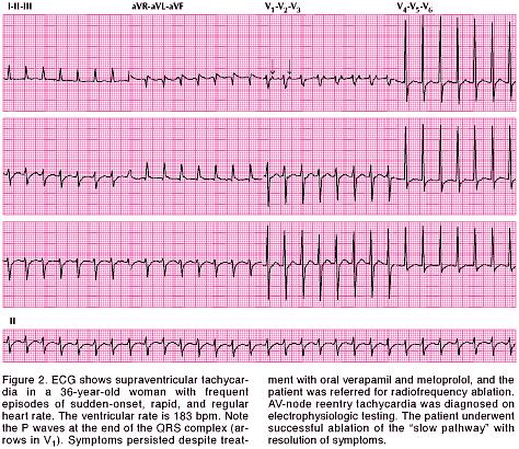 tahikardija Frekvenca srca od 150-250/min P-val se često spaja sa T valom ili