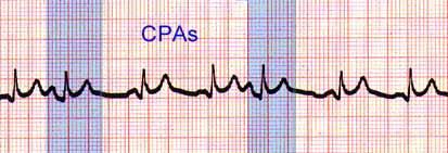 Ekstrasistole Supraventrikularne Atrijalne i nodalne Prematurne, abnormalni P val Nekompezatorna pauza QRS-neizmjenjen U bolesnom i zdravom srcu Ventrikularne Nomotopne, politopne Couplets, salve