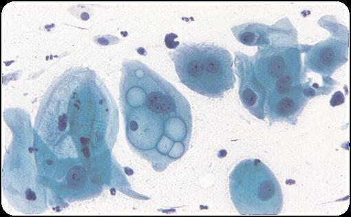 trachomatis Mycoplasma genitalium