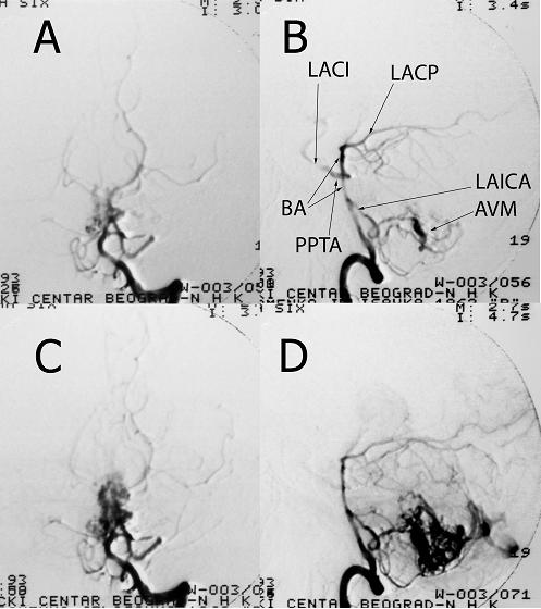 anterior (slika 4A, C). Desna arterija cerebri posterior bila je fetalnog tipa i snabdevala se krvlju iz desne karotidne arterije (slika 5).