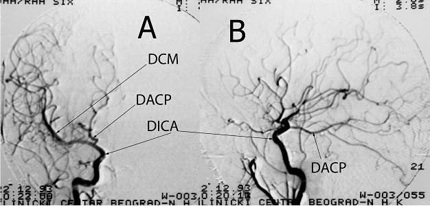 primitivna trigeminalna arterija (PPTA) koja snabdeva bazilarnu arteriju (BA) u gornjoj polovini.