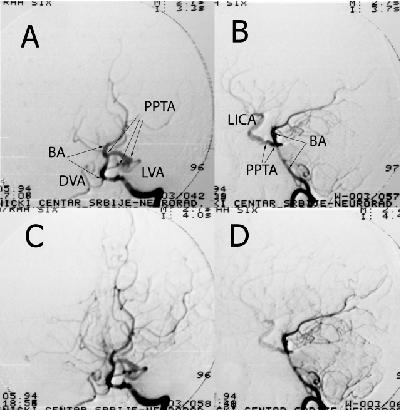 5 Desna karotidna angiografija potpuno odsustvo A1 segmenta desno i fetalni tip arterije cerebri posterior koja se snabdeva samo iz desne unutrašnje karotidne arterije (DICA) preko zadnje