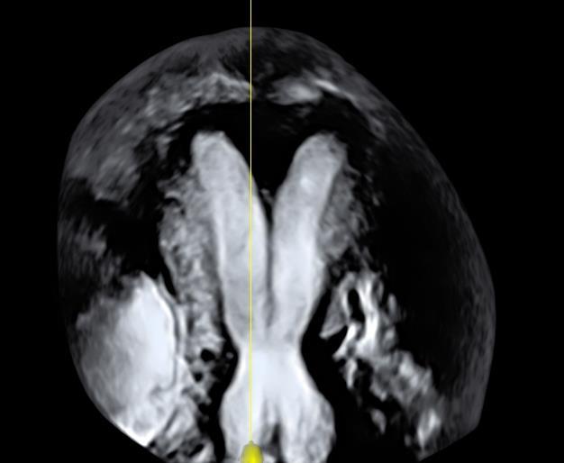 Slika 1: Ultrazvučna slika anomalije maternice, s dopuštenjem dr. sc. Olivera Vasilja, KB Sveti Duh Iz UVP-a razvijaju se maternica i gornja trećina rodnice.