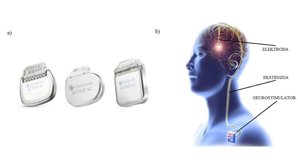 3. UVOD Duboka mozgovna stimulacija (DBS) je neurokirurški postupak koji se sastoji od implantacije neurostimulatora ( moždani pacemaker ) koji odašilje električne impulse kroz ugrađene elektrode u