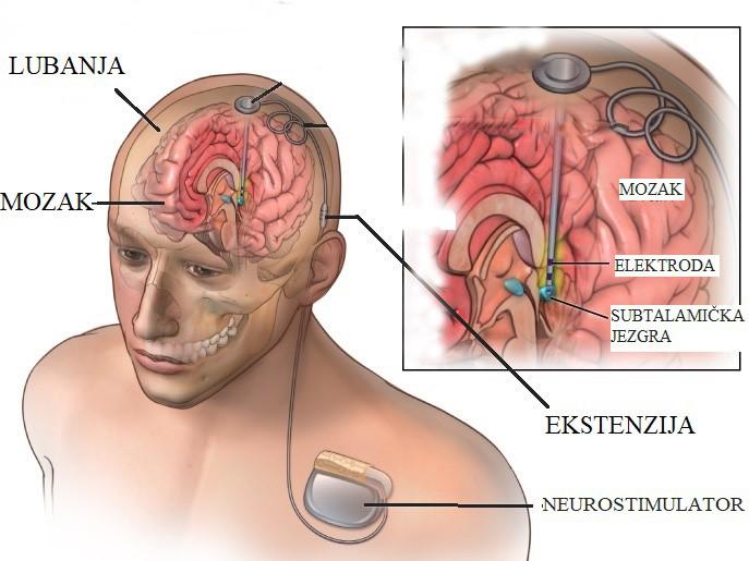 Smještaj elektroda u mozgu ovisi o tipu simptoma koje želimo umanjiti ili u potpunosti inhibirati.