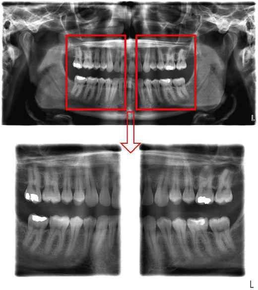 Panoramski program za bočne lukove zuba Panoramski program za bočne lukove zuba (Bitewing) Prikazuje bočne lukove zuba kao snimke oblasti premolara i molara, uključujući i delove gornje i donje