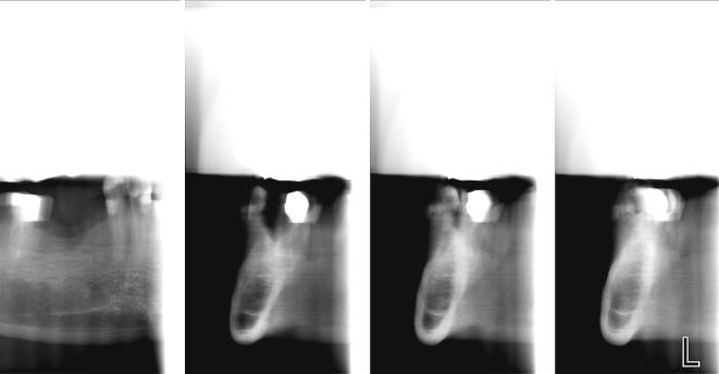 2D tomografski programi Mešoviti tomogrami 1 snimak
