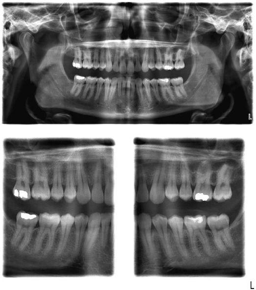 Ekstraoralni bočni lukovi zuba Šta su prednosti ekstraoralnog snimka bočnih lukova zuba?