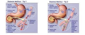8.2. Diabetes mellitus tip 2 Kod DM 2 ili dijabetesa neovisnog o inzulinu, gušterača izlučuje inzulin, ali u manjim količinama nego je potrebno, ili inzulin koji proizvede ne funkcionira pravilno.