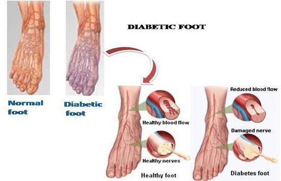 Zbog gubitka osjeta stopalo je veoma podložno ozljedama. Razlozi nastajanja promjena na stopalima mogu biti traume, infekcije, deformiteti, nedostatak higijene, neredovita samokontrola.
