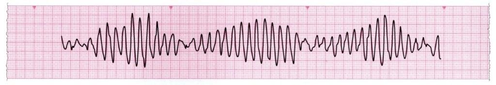 Često se pojavljuje u bolesnika koji u EKG-u imaju produljen QT interval koji može biti kongenitalan, izazvan lijekovima ili hipokalijemijom.