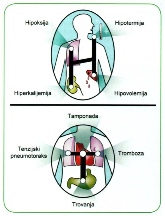 5.5.2. Četiri T Tenzijski pneumotoraks može biti primarni uzrok električne aktivnosti bez pulsa i komplikacija postavljanja CVK. Dijagnoza se postavlja na temelju kliničke slike.