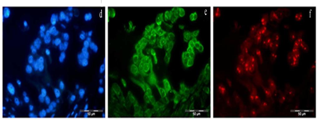 infiltrativnoj tumorskoj zoni tkiva dojke pomoću DAPI filtera. b zeleni signali se odnose na centromerične regione hromozoma 17 CEN 17.