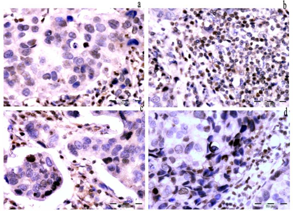 Specifičan tip ekspresije BRCA1 proteina u tumorskim ćelijama četiri molekularna tipa karcinoma dojke prikazan je na slici 8. Slika 8.