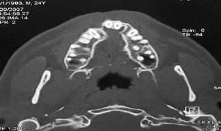 1 Panoramic radiograph before secondary alveolar cleft bone grafting of