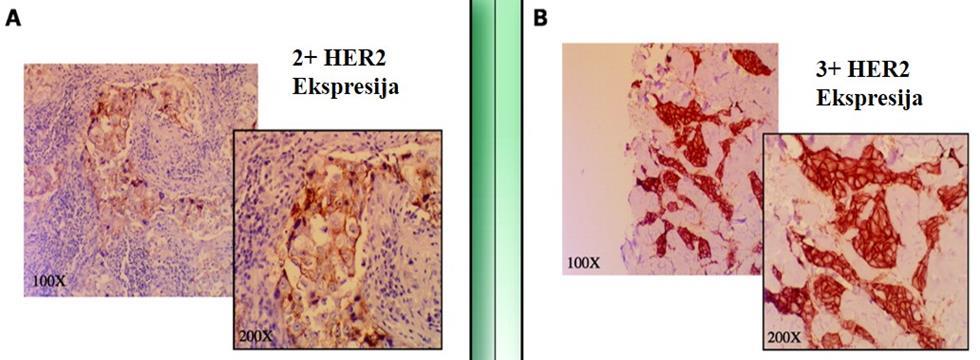 Slika 2.5. Imunohistokemijski prikaz (IHC) bojanja membrane tumorske stanice na ekspresiju receptora HER2.