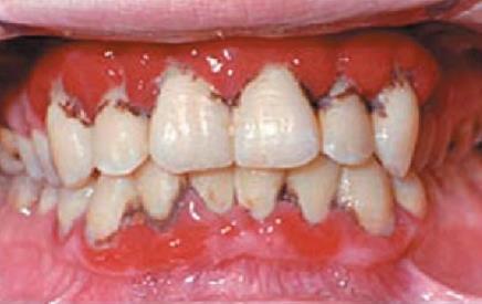 Slika 2. Prikaz sluĉaja. Streptokokni gingivitis.