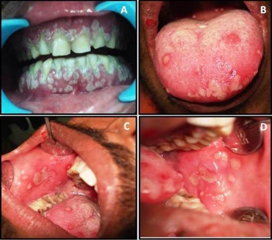 Slika 3. Herpetiĉni gingivostomatitis.